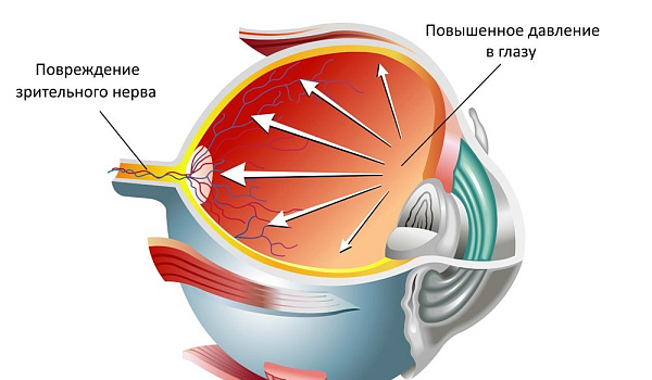 Глазное давление - причины, симптомы, лечение внутриглазного давления